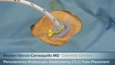Percutaneous Endoscopic Gastrostomy Peg Tube Placement Technique Placement Of Percutaneous Endoscopic Gastrostomy Tube Complications