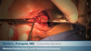 Surgery for Piles