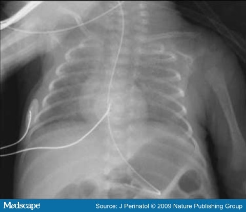 Osteopenia of Prematurity, Staphylococcal Rib Osteomyelitis