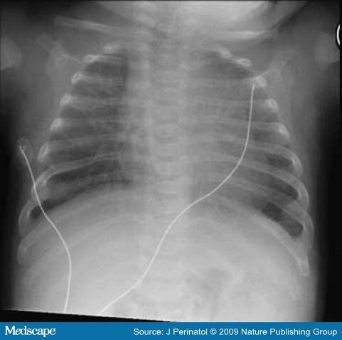 Osteopenia of Prematurity, Staphylococcal Rib Osteomyelitis