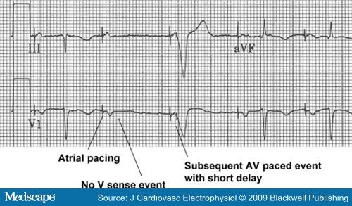 Pacing Features That Mimic Malfunction