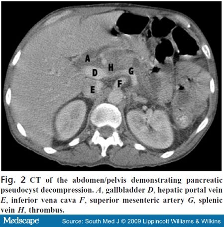 Portal Vein Ct