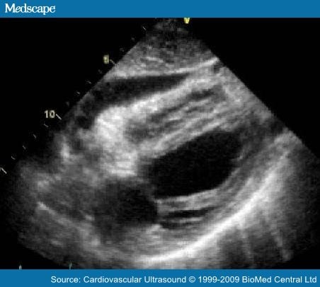 Pseudo Cardiac Tamponade in the Setting of Excess Pericardial Fat