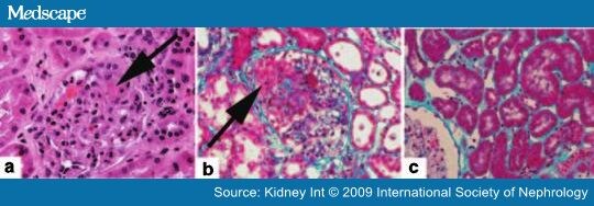 The Renal Consult: Churg-Strauss Syndrome