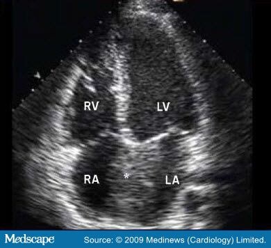 : The Value Of Echocardiography in Atrial Fibrillation