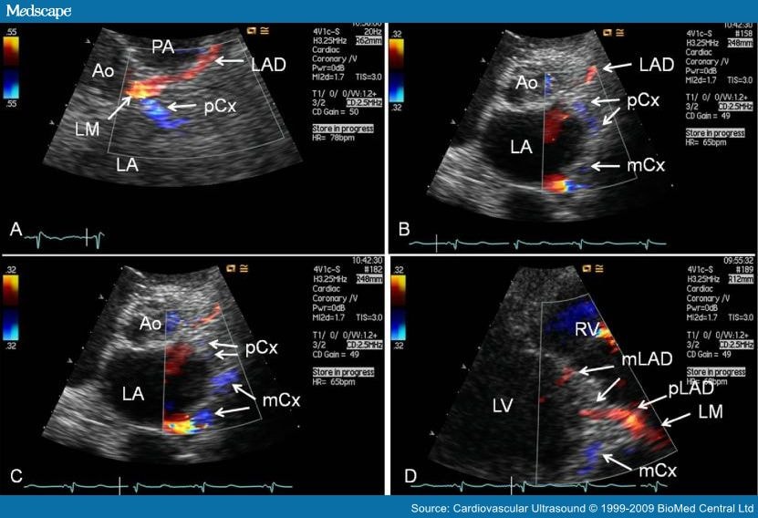 Transthoracic Echocardiography for Imaging the Coronary Artery Segments