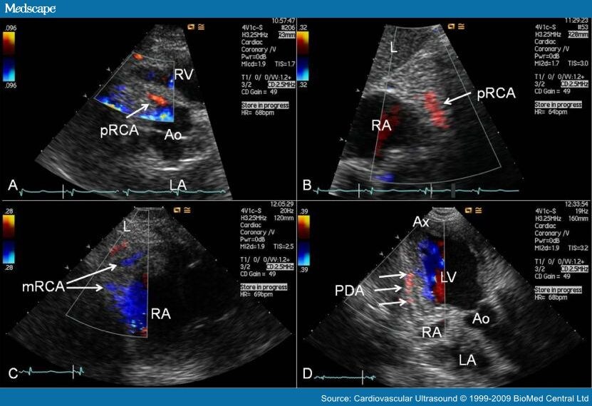 Transthoracic Echocardiography for Imaging the Coronary Artery Segments