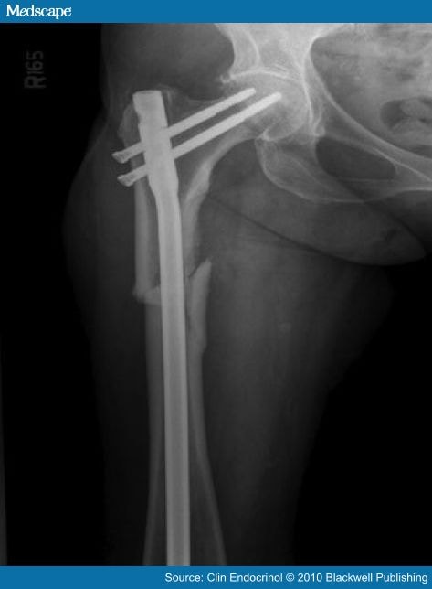 Unusual Mid-shaft Fractures During Long-term Bisphosphonate Therapy