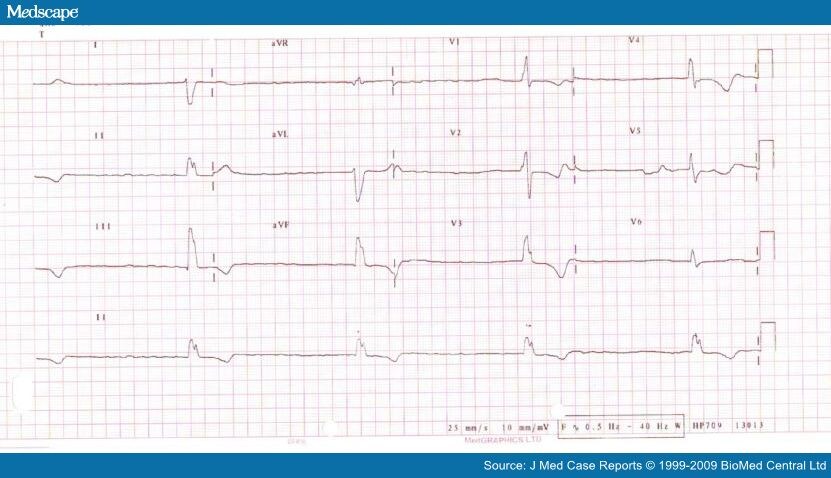 Presentation of Thyrotoxicosis as Complete Heart Block and Renal Failure