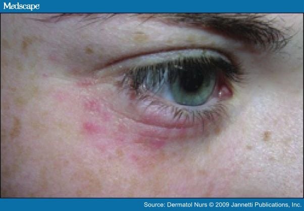 red spots on eyelids #11