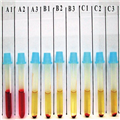 Detection and Significance of Donath-Landsteiner Antibodies in a 5-year ...