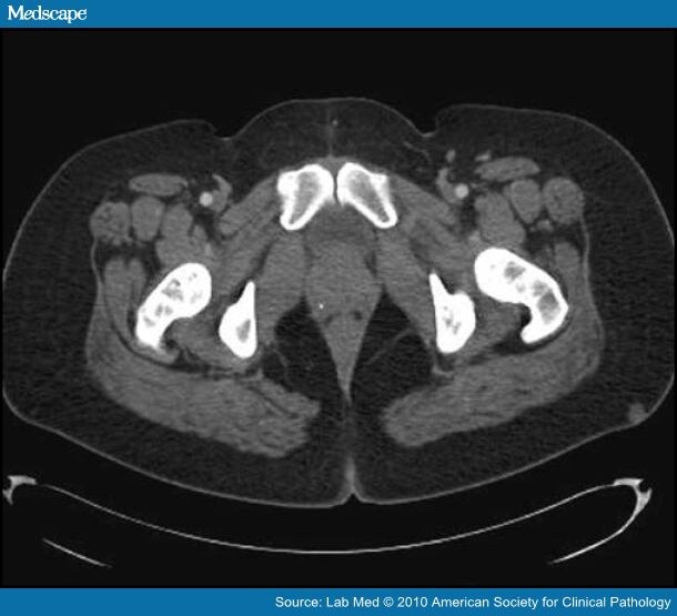 Proximal-Type Epithelioid Sarcoma