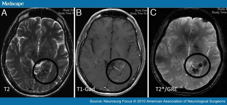 Emerging Clinical Imaging Techniques for Cerebral Cavernous Malformations