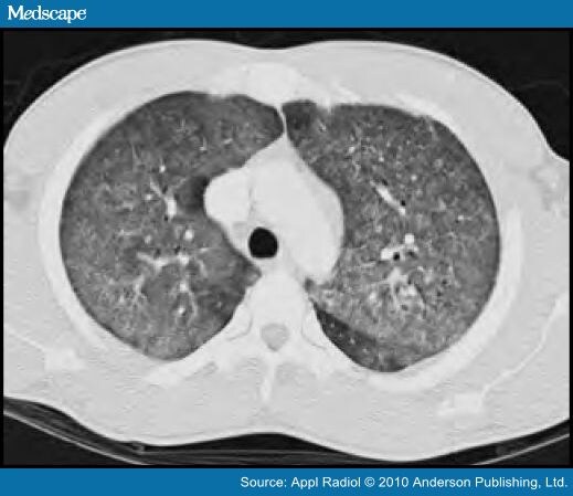 Fulminant Pneumonia With Cavitary Destruction of Lung Parenchyma