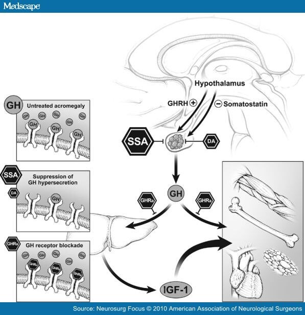 Acromegaly: Review of Current Medical Therapy and New Drugs on the Horizon