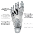 Remission of Severe Restless Legs Syndrome After Excision of Foot Neuromas