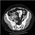 Stump Appendicitis