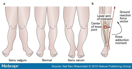 Muscle Weakness, Afferent Sensory Dysfunction and Exercise in Knee ...