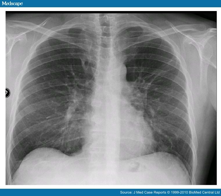 Eosinophilic Infiltrate in a Patient With Severe Legionella Pneumonia