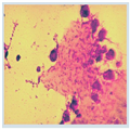 Pseudomonas aeruginosa Biofilms in Cystic Fibrosis