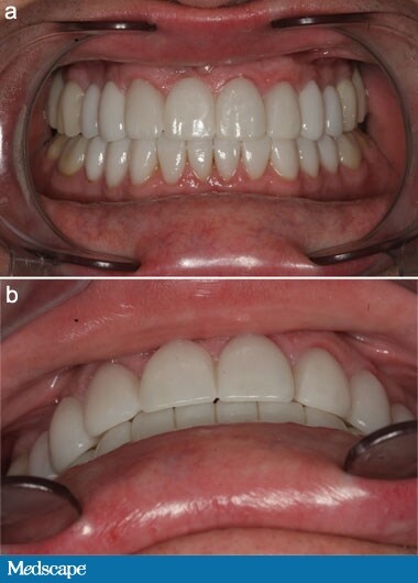 Dental Occlusion, Balanced