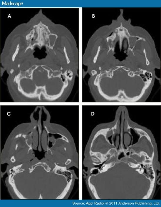 Bisphosphonate Associated Osteonecrosis of the Jaw