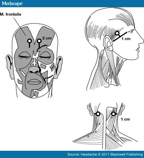 Botulinum Type A Toxin Complex for Migraine Without Aura