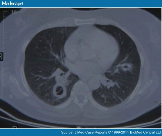 Endobronchial Hemorrhage in Bronchopulmonary Mucormycosis