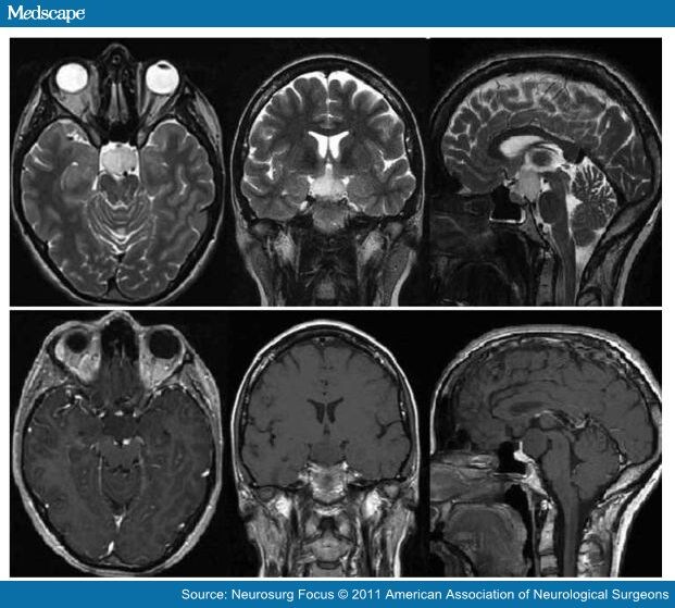 Deep Brain Stimulation in Hypothalamic Hamartoma