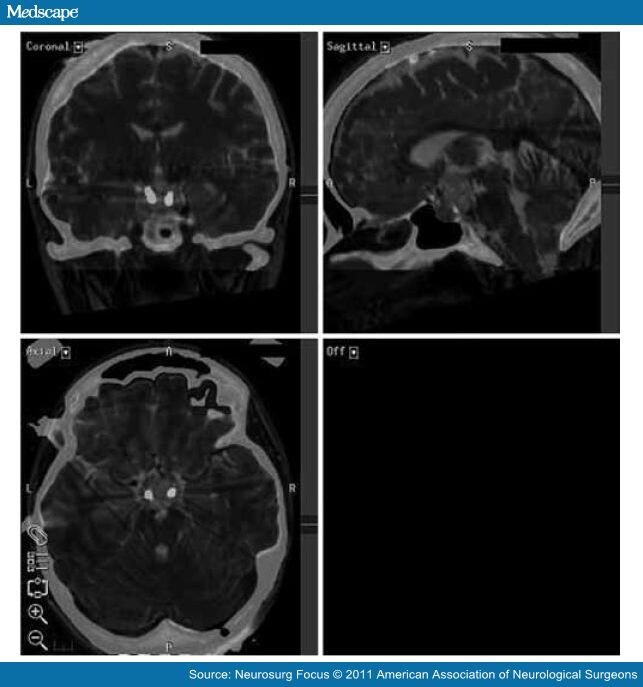 Deep Brain Stimulation in Hypothalamic Hamartoma