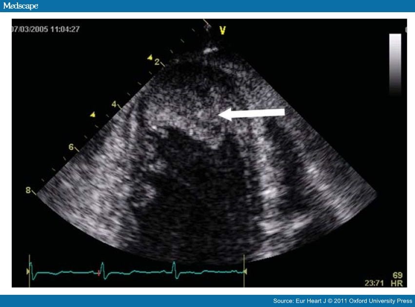 Laminated Lv Apical Thrombus