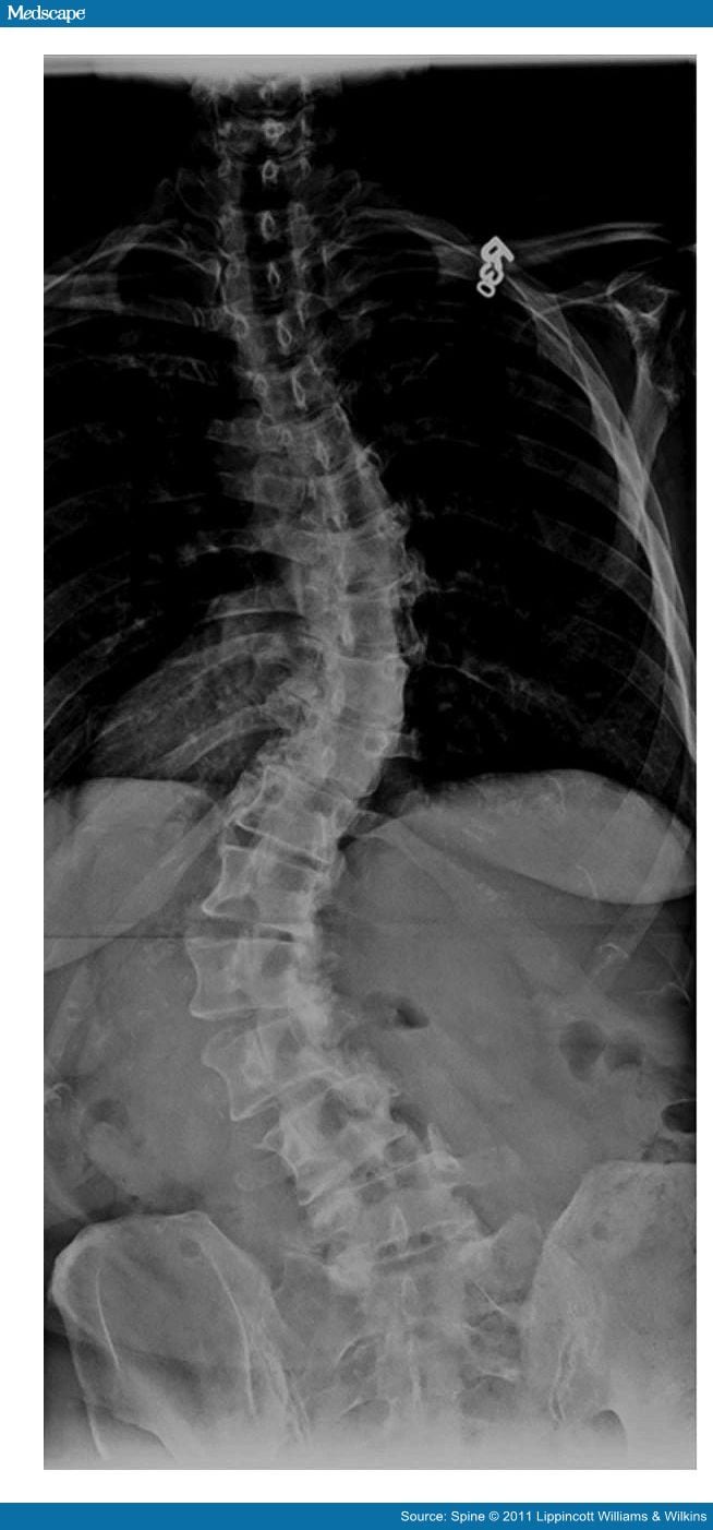 Scoliosis in Adults Aged Forty Years and Older