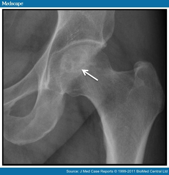 Radiofrequency Ablation for Osteoid Osteoma of Femoral Head