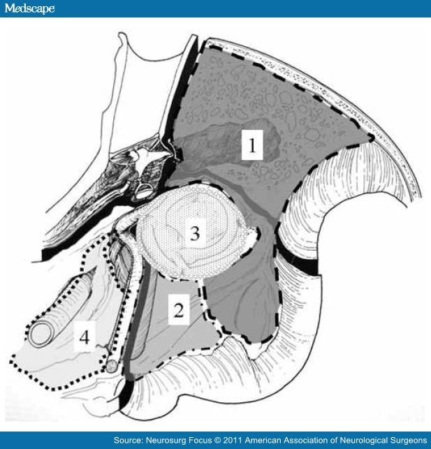 The Surgical Approach of Posterior Petrous Bone Meningiomas