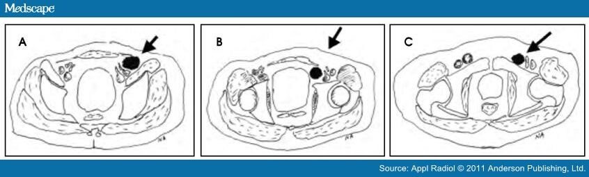 Review of Inguinal Region Hernias on MDCT diagram of femoral hernia 