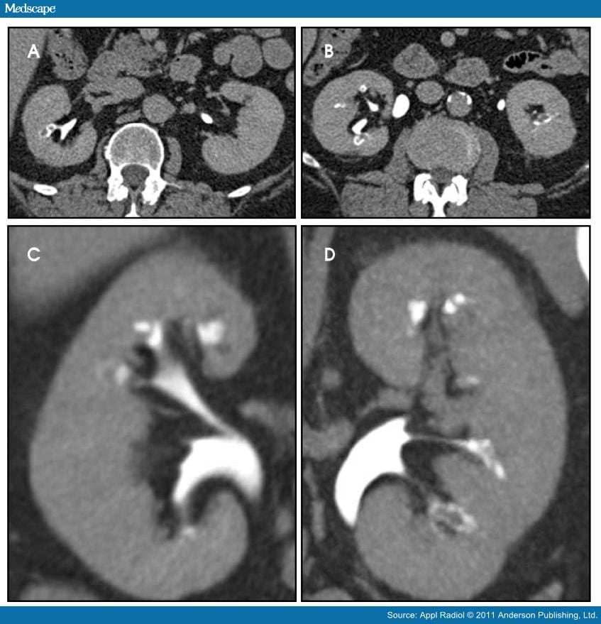 Kidney Papillary Necrosis; Renal Papillitis, Necrotizing