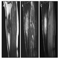 Chronic Osteomyelitis of the Tibia With a Brodie's Abscess