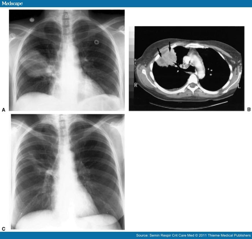 Wegener Granulomatosis: Evolving Concepts in Treatment