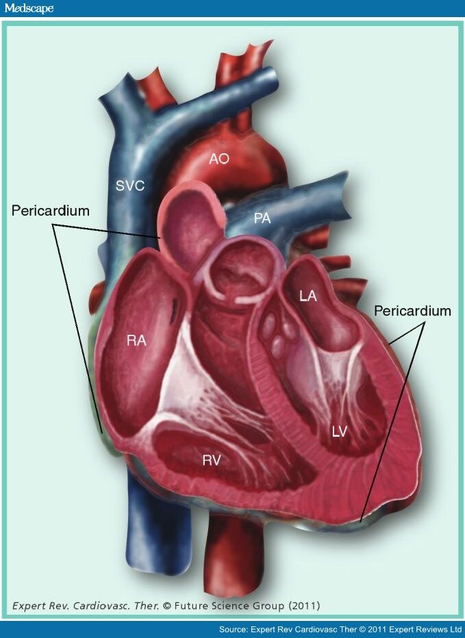 Evaluation and Management of Pericarditis