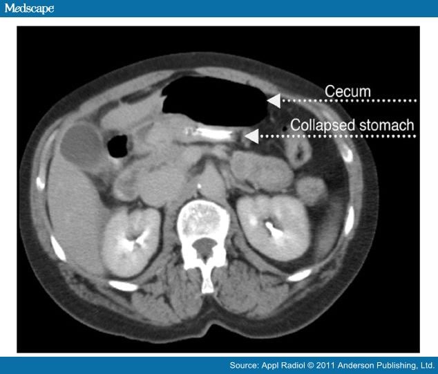 Cecal Bascule With Concurrent Acute Appendicitis