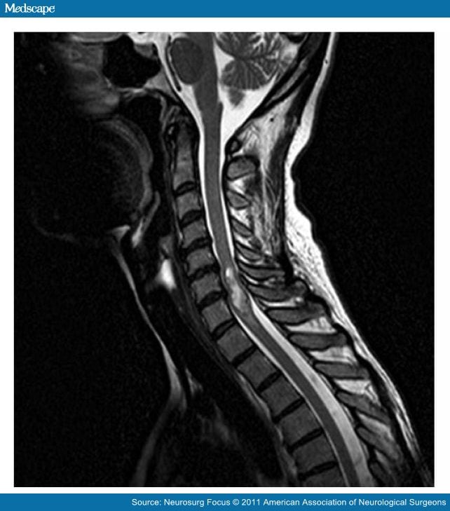 Complications With Treatment for Spinal Ependymomas