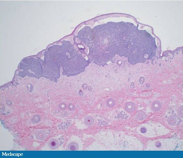 Basal Cell Nevus Syndrome in a 9-Year-Old Boy