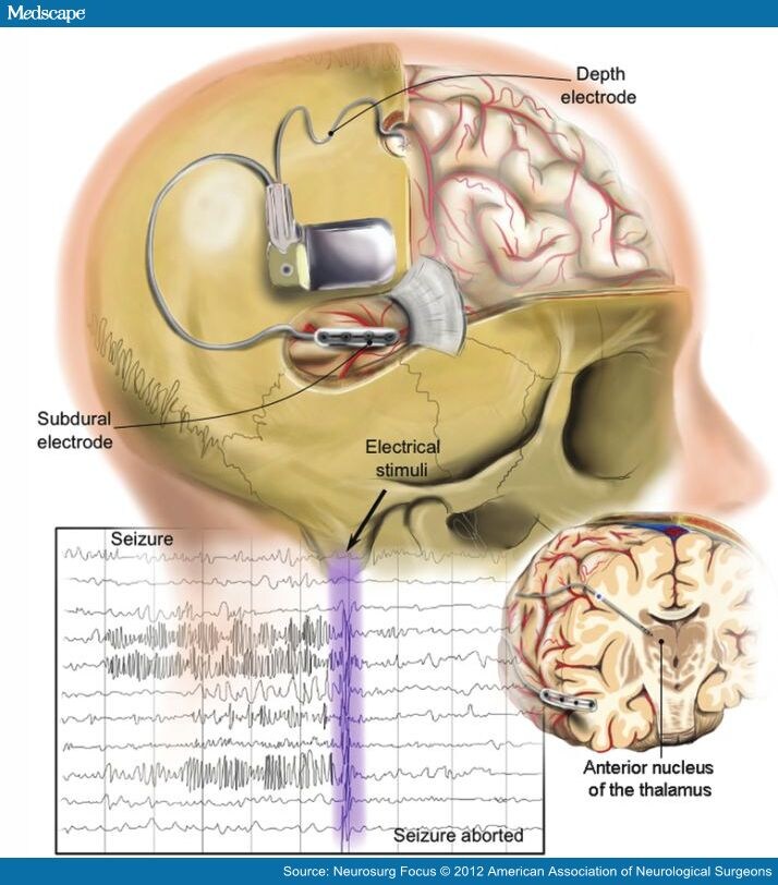 Brain Stimulation for the Treatment of Epilepsy