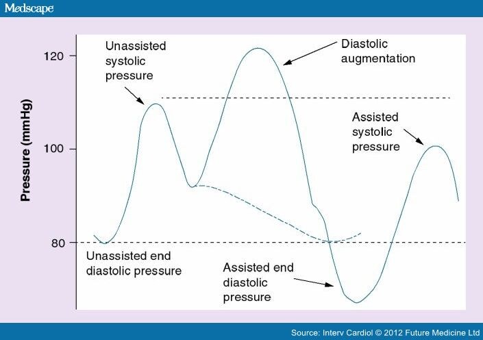 The Intra-aortic Balloon Pump in High-risk PCI