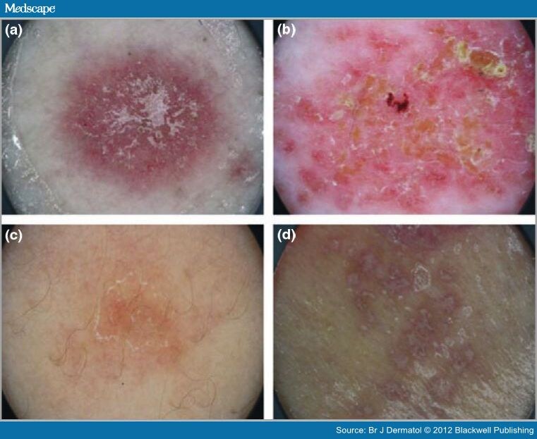 Dermoscopy for Diagnosis of Inflammatory Skin Diseases