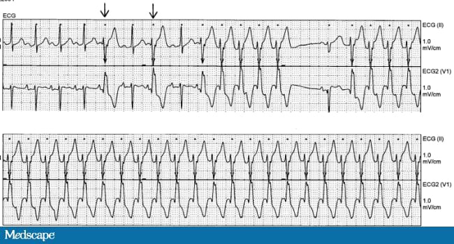 Ekg Strip Search Supraventricular Tachycardia Svt Emergency Room Images