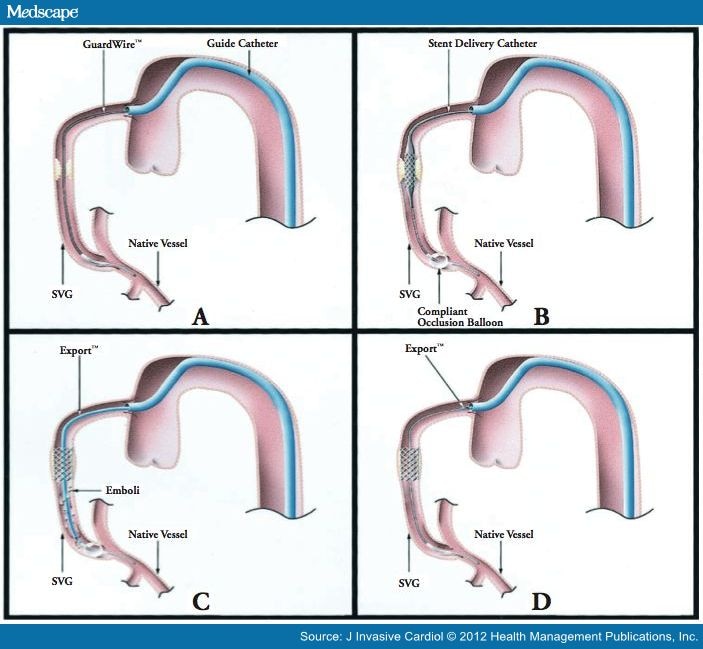 Saphenous Vein Graft Intervention