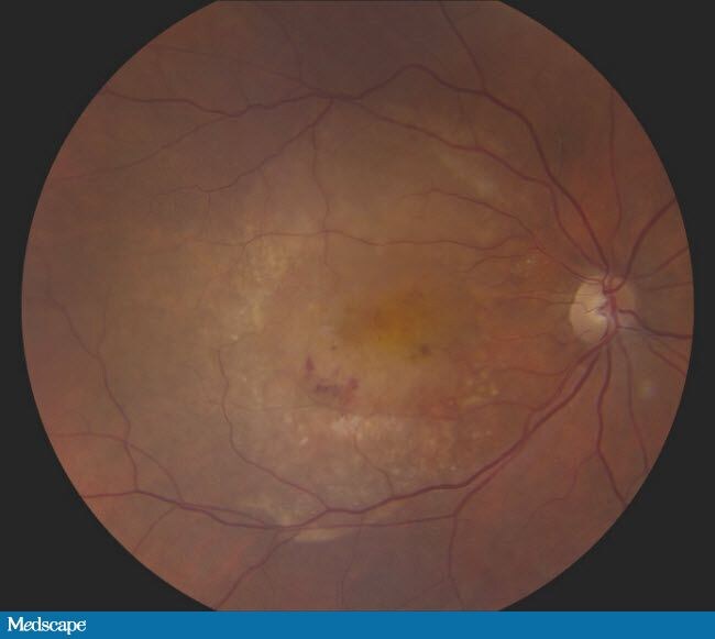 Age-Related Macular Degeneration: A Primer