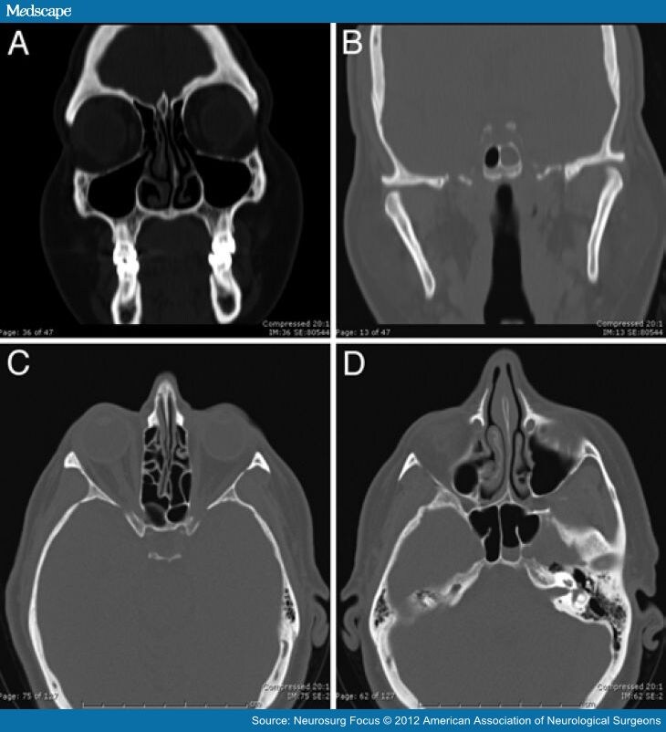 CSF Rhinorrhea Following Anterior Skull Base Fractures