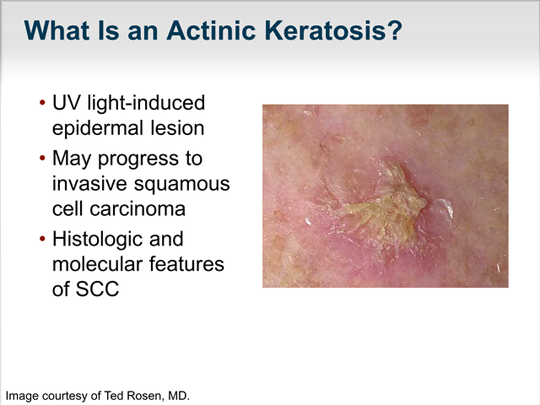 Paradigms in the Treatment of Actinic Keratosis (Transcript)